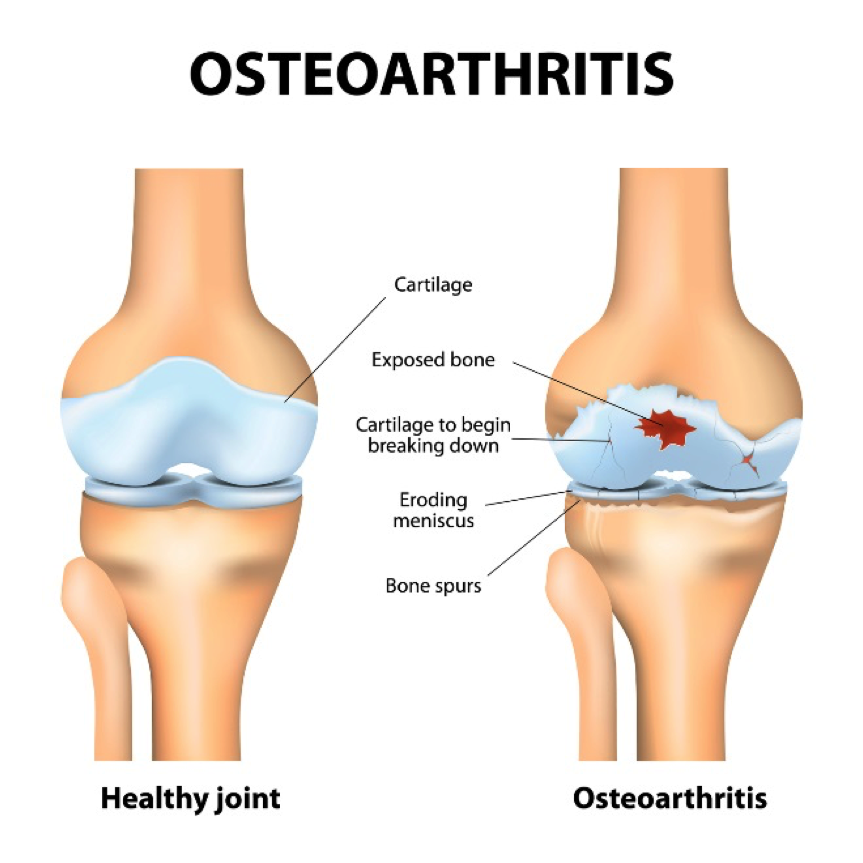 osteoarthritis